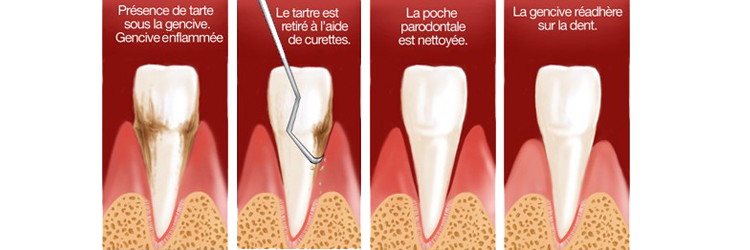 Surfaçage radiculaire - Cabinet dentaire Drs Frédérique et Sylvia Mercier - Dentiste Faches Thumesnil