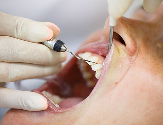 Assainissement parodontal - Cabinet dentaire Drs Frédérique et Sylvia Mercier - Dentiste Faches Thumesnil