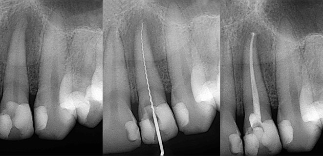 Endodontie - Cabinet dentaire Drs Frédérique et Sylvia Mercier - Dentiste Faches Thumesnil