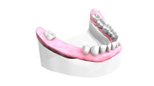 Examen pré-implantaire - Cabinet dentaire Drs Frédérique et Sylvia Mercier - Dentiste Faches Thumesnil