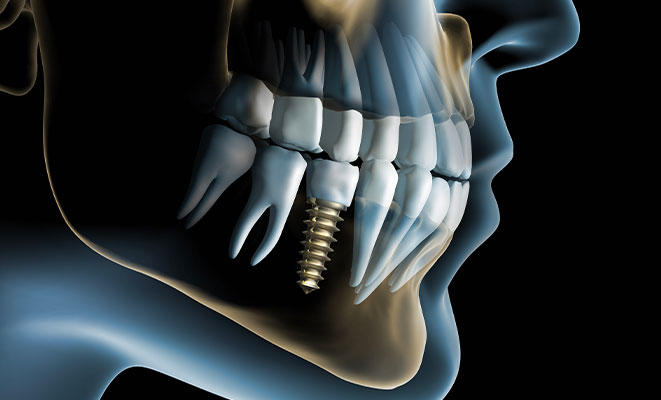 Implants dentaires - Cabinet dentaire Drs Frédérique et Sylvia Mercier - Dentiste Faches Thumesnil