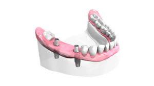 Pose implants dentaires - Cabinet dentaire Drs Frédérique et Sylvia Mercier - Dentiste Faches Thumesnil