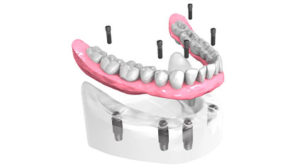 Mise en place implants dentaires - Cabinet dentaire Drs Frédérique et Sylvia Mercier - Dentiste Faches Thumesnil
