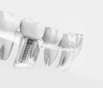 Implantologie - Cabinet dentaire Drs Frédérique et Sylvia Mercier - Dentiste Faches Thumesnil